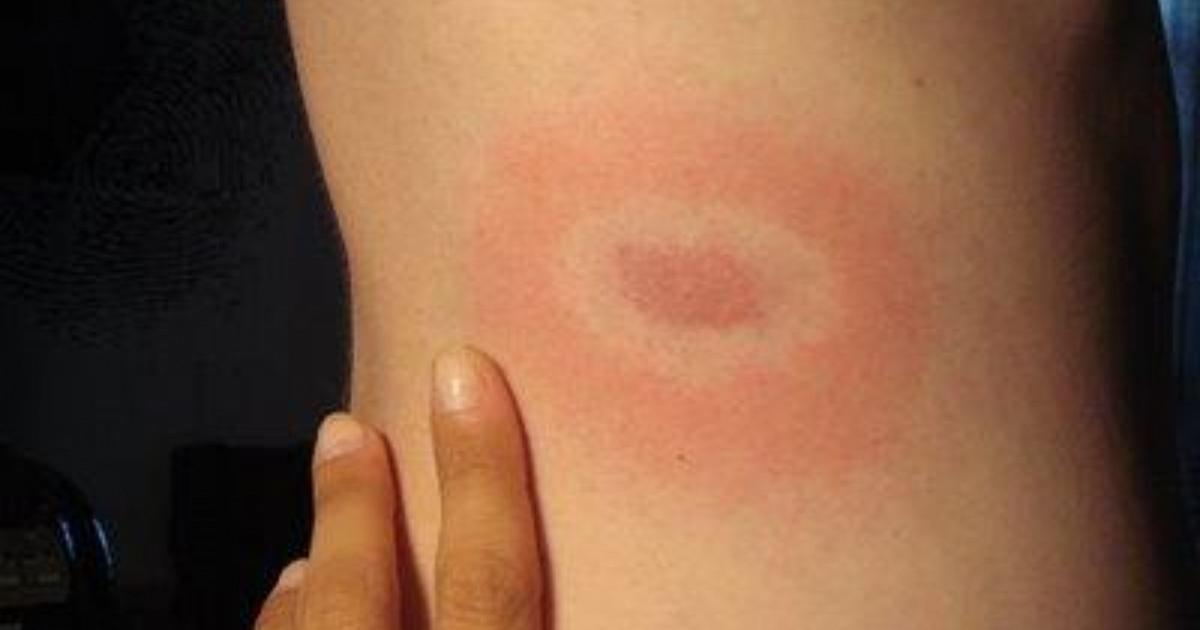 Lyme hastalığı: nasıl bulaşır, seyri ve tedavileri