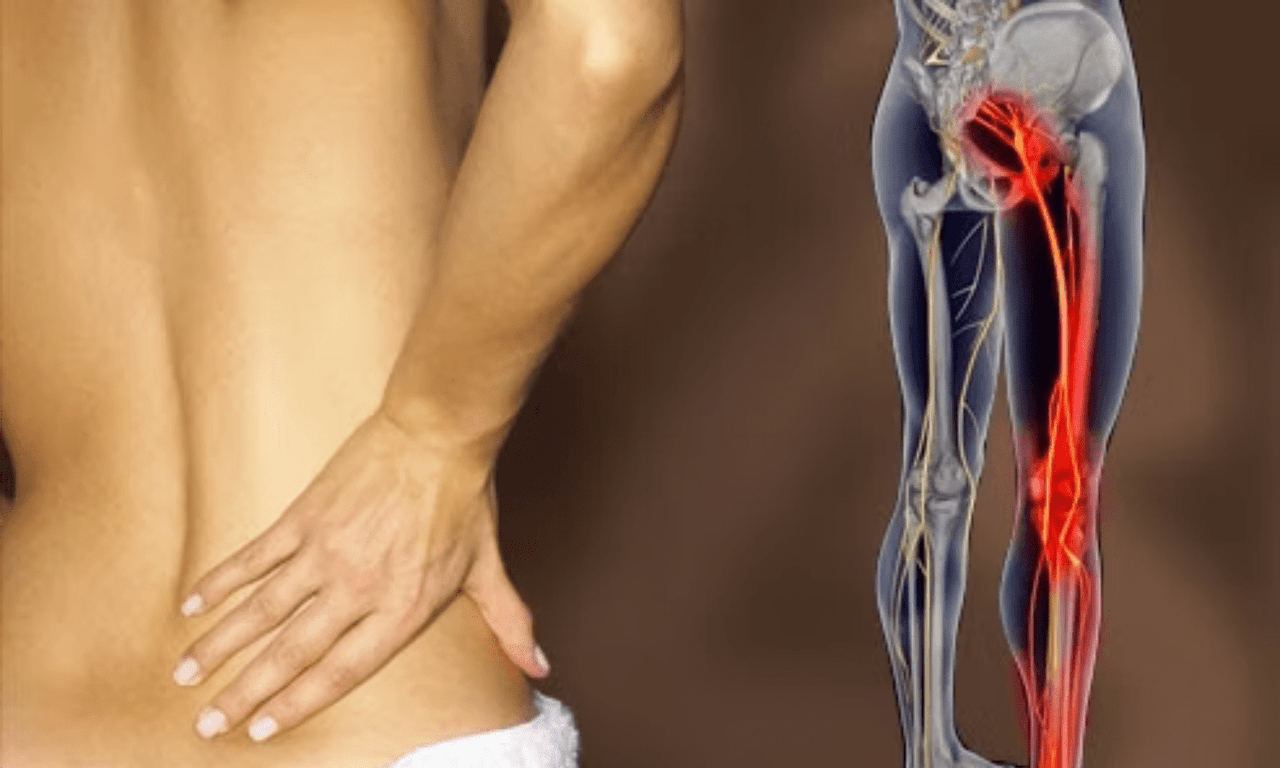Douleur sciatique : comment l’identifier, quelles en sont les causes et comment la soulager