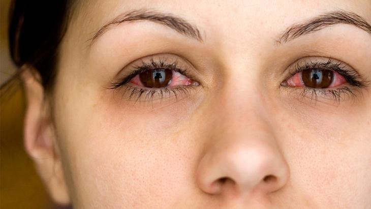 Le rhume hivernal affecte aussi vos yeux ! Il peut être contagieux, alors suivez ces conseils si vous présentez des symptômes.