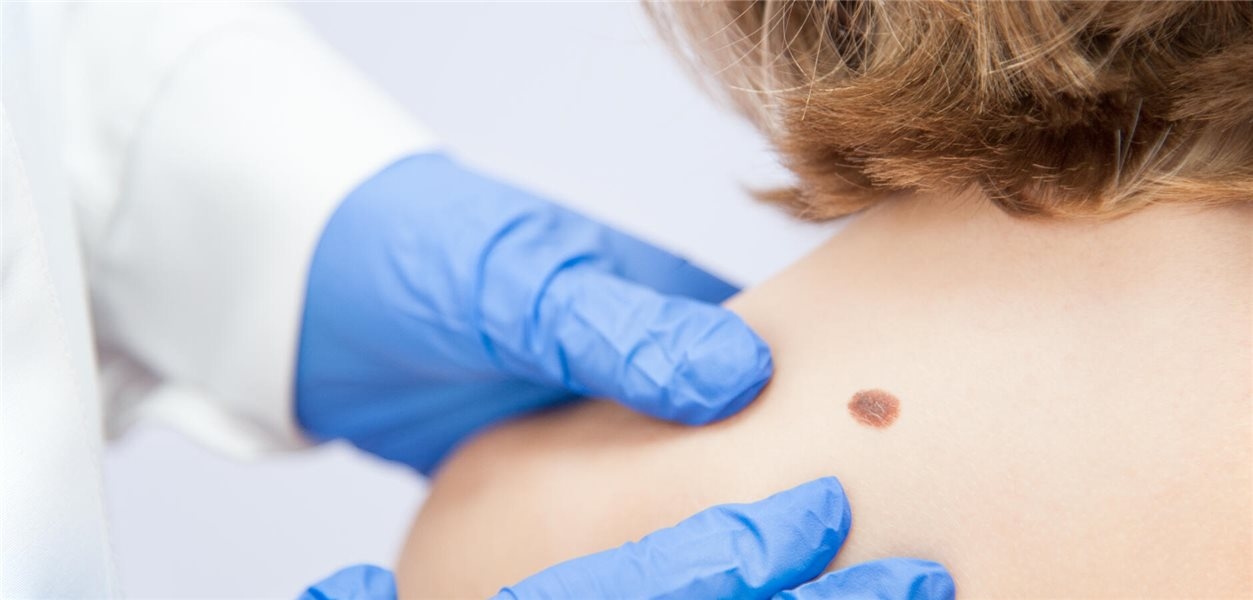 Early melanomas probably do not pose an increased risk for pregnant women