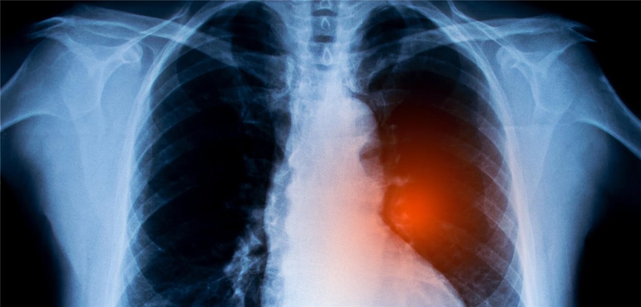 Nicht-kleinzelliges Lungenkarzinom: Krebsimpfstoffe könnten Überlebenschancen erhöhen