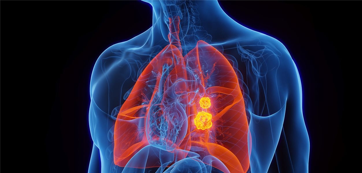 EGFR-mutiertes NSCLC: Was für Diagnostik und Therapie wichtig ist